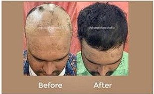 After Hair Density Restoration