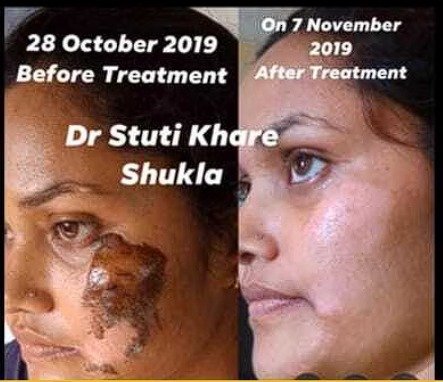 After Burn Scar Care