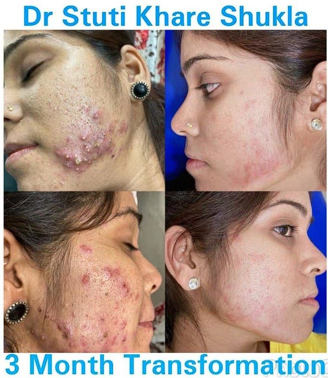After Acne Therapy